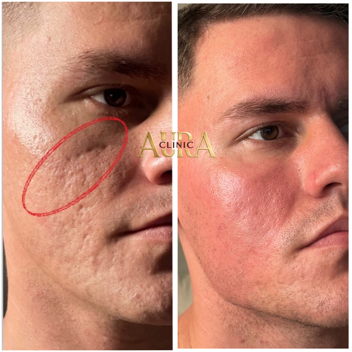 Resultado masculino antes e depois do protocolo para cicatrizes de acne